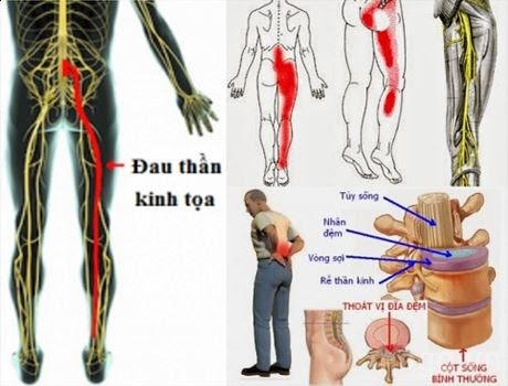 đau dây thần kinh tọa