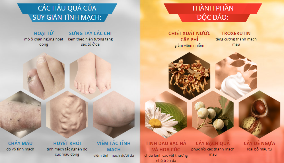 varikosette hỗ trợ điều trị suy giãn tĩnh mạch