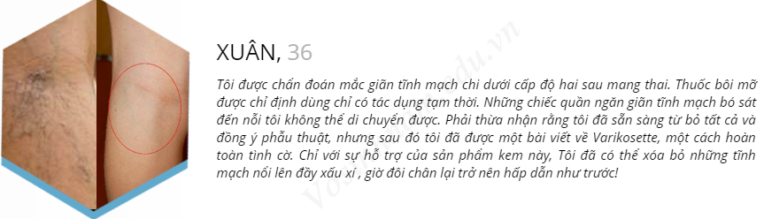 varikosette hỗ trợ điều trị suy giãn tĩnh mạch