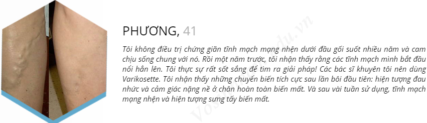 varikosette hỗ trợ điều trị suy giãn tĩnh mạch